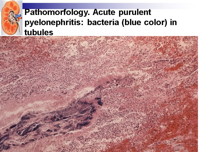 Pathomorfology. Acute purulent pyelonephritis: bacteria (blue color) in tubules